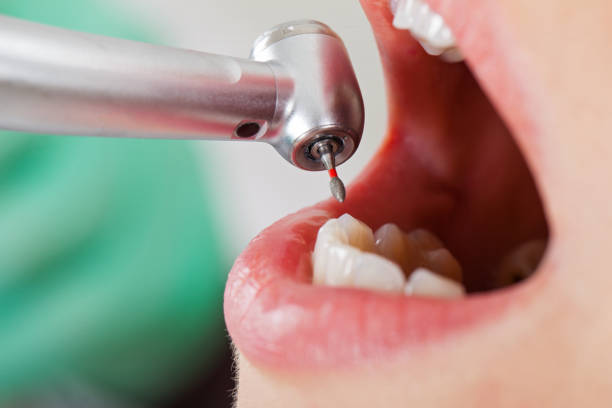Best Emergency Dental Care for Abscessed Tooth in Mendon, IL